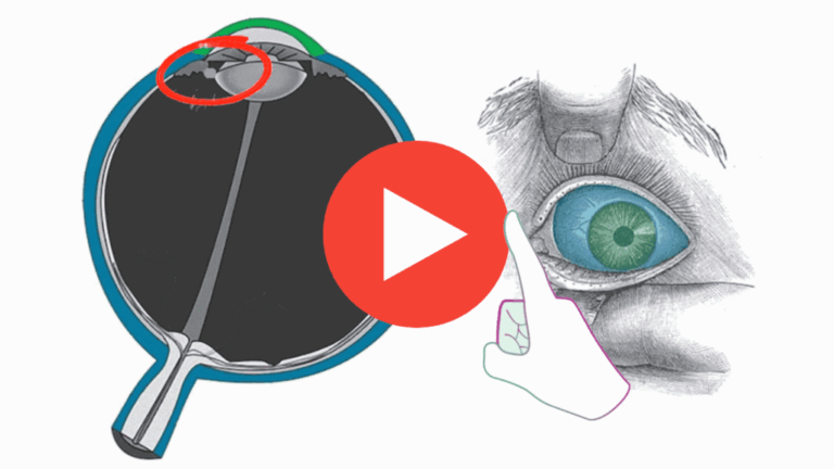 Natural Vision Restoration
